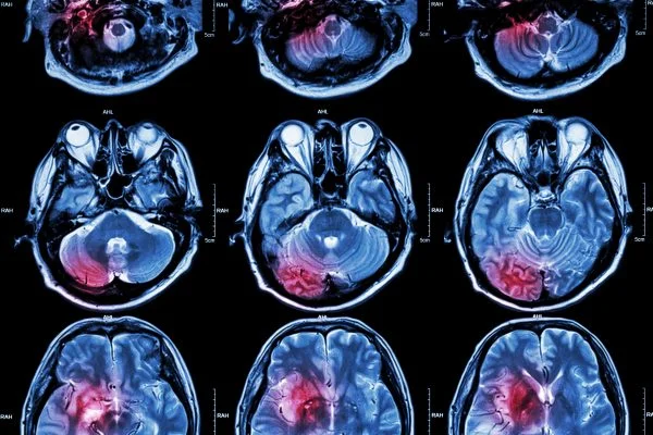 magnetic-resonance-imaging-of-brain