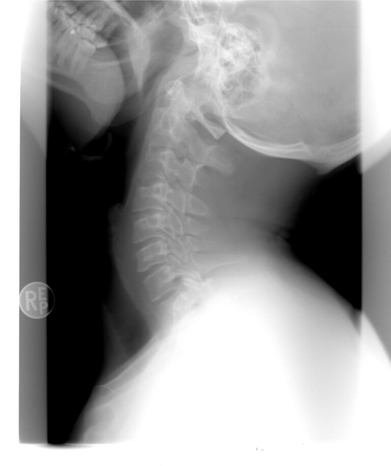East Bay catastrophic injury lawyer at Mirador Law